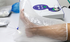 ozonioterapia micoses