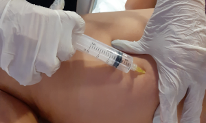 Ozonioterapia - Enfermagem