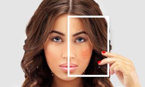 melasma-tratamentos
