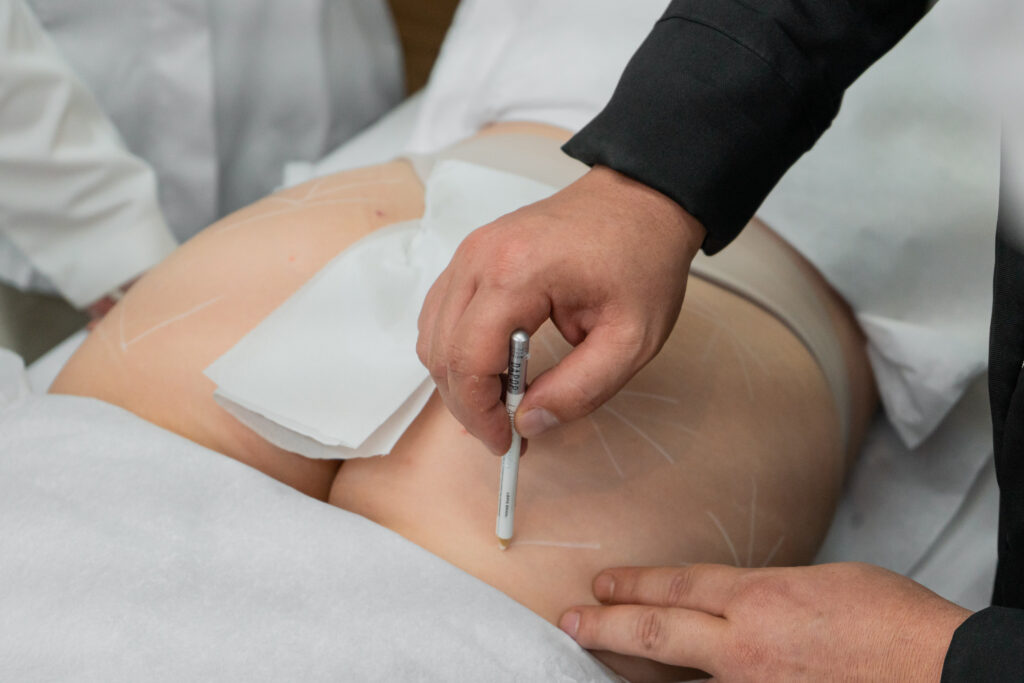 Glúteo dos sonhos: o que o Enfermeiro Esteta pode fazer com bioestimuladores e enzimas
